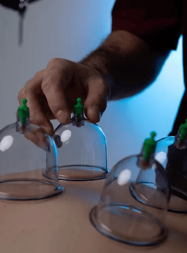 Cupping Therapy