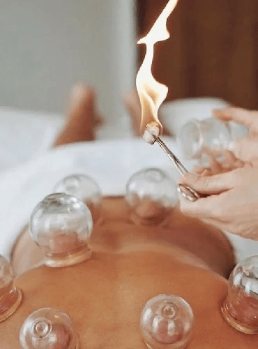 Hijama Therapy