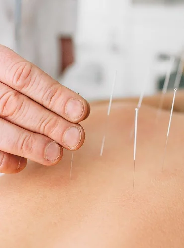 Needling Therapy